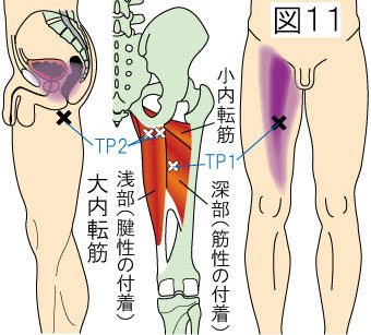 大内転筋トリガーポイントによる骨盤内と大腿の痛み