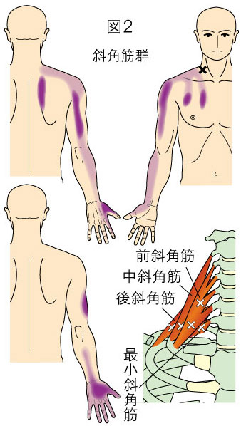 斜角筋トリガーポイントによる胸、上背部、上肢の痛み