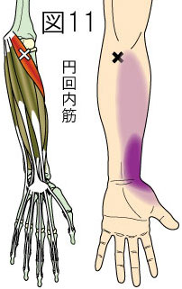 円回内筋トリガーポイントによる前腕・手の痛み