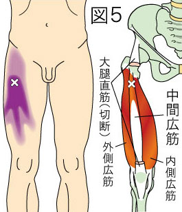 中間広筋トリガーポイントによる大腿の痛み