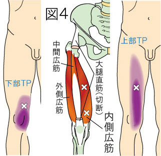 内側広筋トリガーポイントによる大腿と膝の痛み