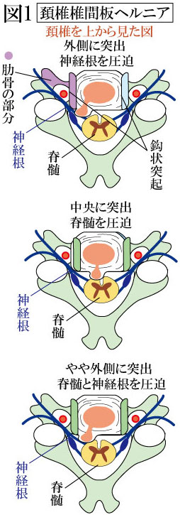 頚椎椎間板ヘルニア