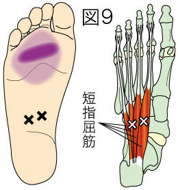 短指屈筋トリガーポイントによる足の痛み