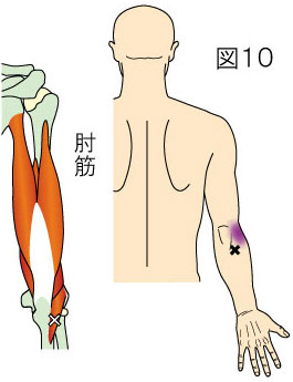 肘筋トリガーポイントによる肘外側の痛み