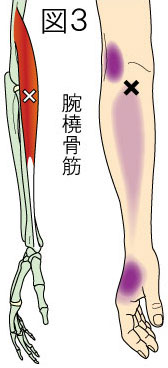 腕橈骨筋トリガーポイントによる肘・前腕・手の痛み