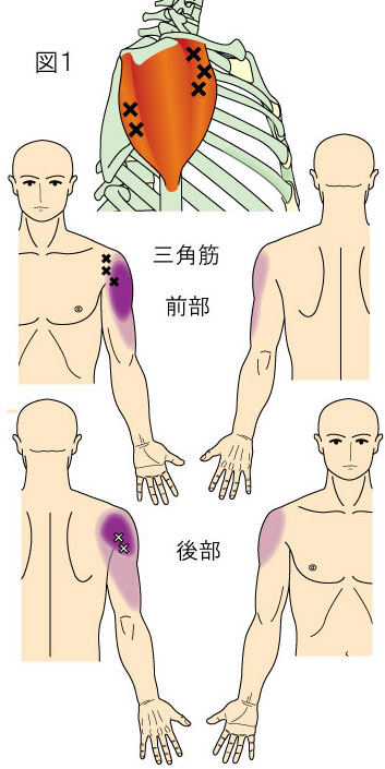 トリガーポイントによる体幹上部と上肢の痛み・2 - やまだカイロ