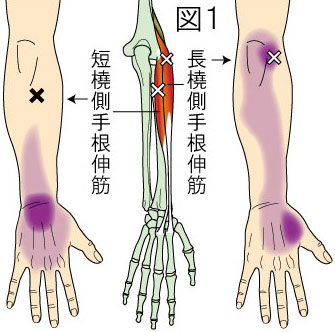 トリガーポイントによる肘 前腕 手の痛み やまだカイロプラクティック 鍼灸院ホーム ページ