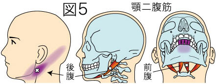 顎二腹筋トリガーポイントによる頭痛と歯の痛み