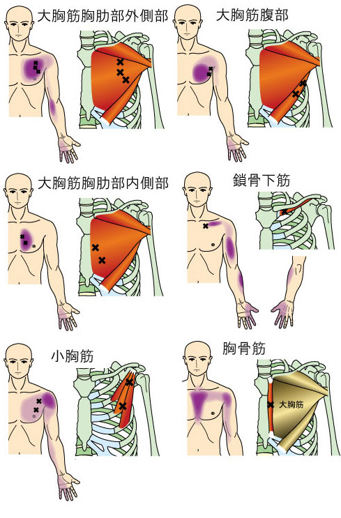 トリガーポイントによる肘・前腕・手の痛み - やまだカイロ トリガーポイントによる肘・前腕・手の痛み - やまだカイロ