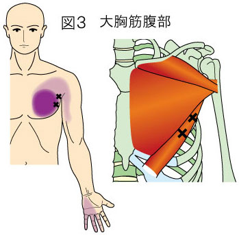 大胸筋腹部トリガーポイントによる胸と手の痛み