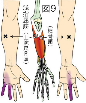 浅指屈筋トリガーポイントによる手と指の痛み