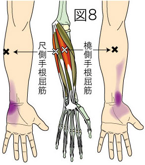橈側・尺側手根屈筋トリガーポイントによる前腕と手の痛み