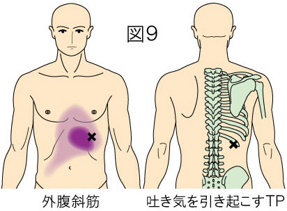 外腹斜筋トリガーポイントによる腹痛・胸痛・吐き気