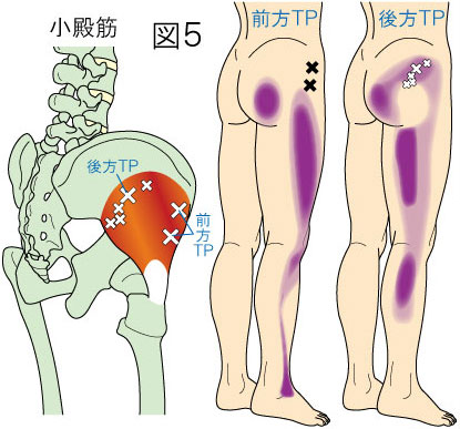 小殿筋トリガーポイントによる殿部・大腿部・下腿部の痛み