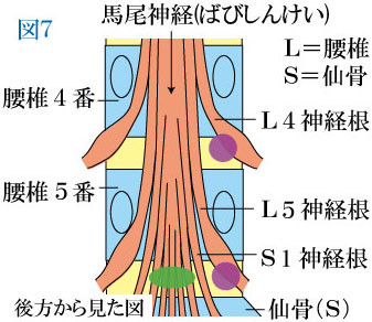 神経根の圧迫・外側型