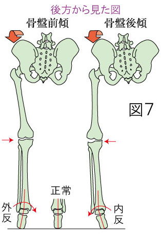 足根管症候群と骨盤