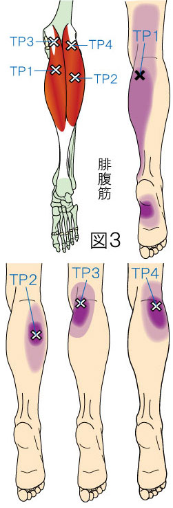 腓腹筋トリガーポイントによる膝・下腿・足の痛み