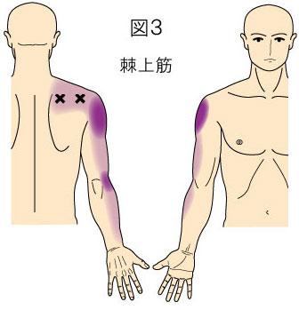 棘上筋トリガーポイントによる肩と上肢の痛み