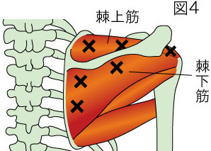 棘上筋、棘下筋トリガーポイント