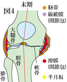 変形性膝関節症　末期