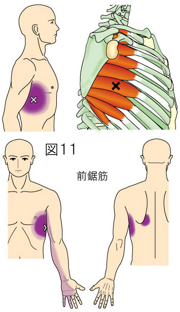 前鋸筋トリガーポイントによる体幹と上肢の痛み