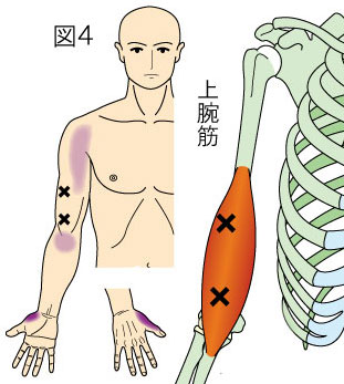 上腕筋トリガーポイントによる親指と肩から肘の痛み