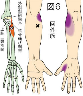 回外筋トリガーポイントによる肘と手の痛み