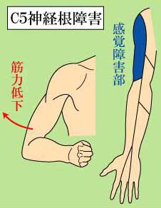頚椎　Ｃ5神経根障害