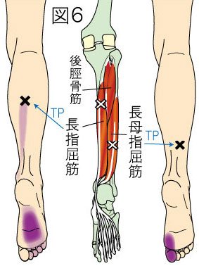 長趾屈筋トリガーポイントによる下腿と足の痛み