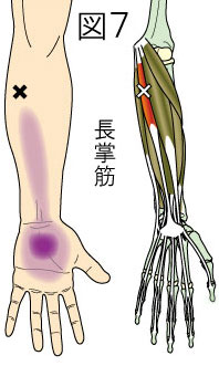 長掌筋トリガーポイントによる前腕と手の痛み