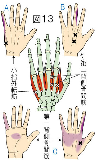 背側骨間筋・小指外転筋トリガーポイントによる手の痛み