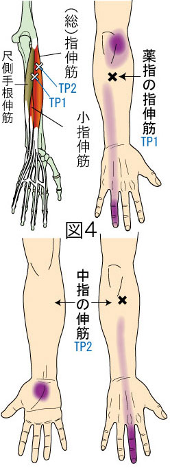 指伸筋トリガーポイントによる肘・前腕・手・指の痛み