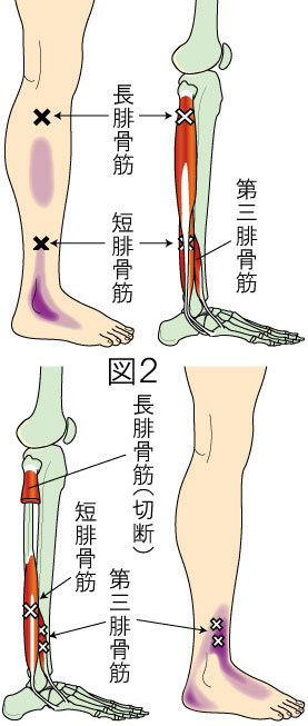 腓骨筋トリガーポイントによる下腿と足の痛み