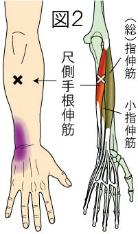 尺側手根伸筋トリガーポイントによる手首の痛み