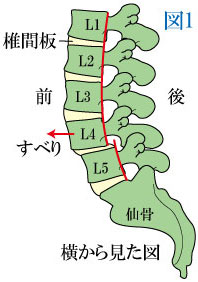 腰椎すべり症