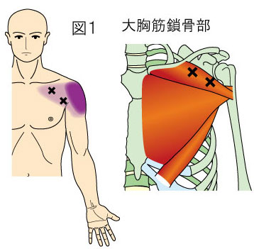 大胸筋鎖骨部トリガーポイントによる胸と肩の痛み