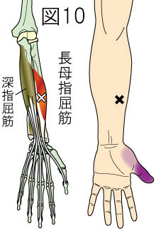 長母指屈筋トリガーポイントによる手・指の痛み