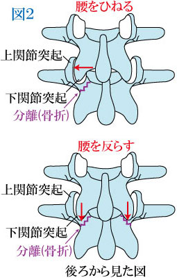 腰椎分離症の発生機序