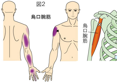 烏口腕筋トリガーポイントによる肩・上腕・前腕・手の痛み