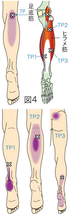 ヒラメ筋・足底筋トリガーポイントによる仙腸関節・膝・下腿・足の痛み