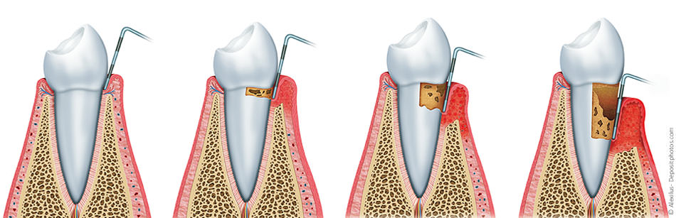 Die Zahnfleischtaschen werden immer tiefer, was mit einer Sonde gemessen werden kann. Das Zahnfleisch entzündet sich, ist dunkelrot und blutet beim Zähneputzen. Die Zähne werden locker und können sogar letztendlich ausfallen.