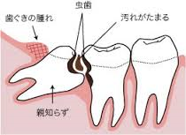 八戸市の歯医者くぼた歯科　親知らず