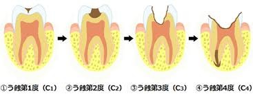 八戸市の歯科くぼた歯科医院乳歯の治療