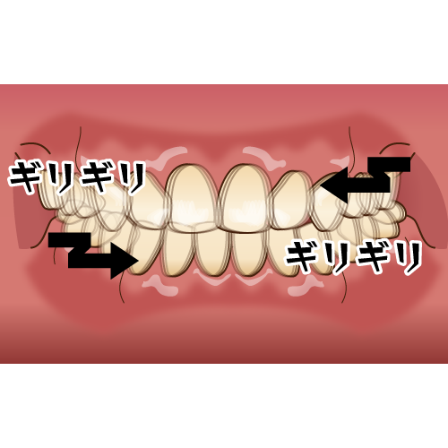 重度の歯周病の人は強く噛み締めている 女性歯科医師のいる優しい歯科医院です 重度の歯周病の人は強く噛み締めている 女性歯科医師のいる優しい歯科医院です