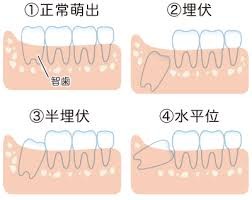 八戸市の歯医者くぼた歯科　親知らず