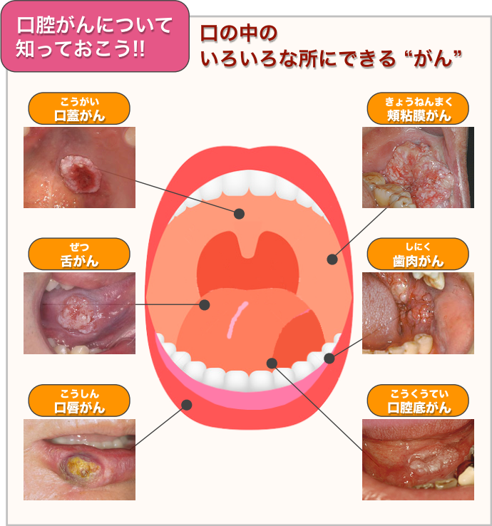 口 の 中 の 粘膜 が 剥がれる