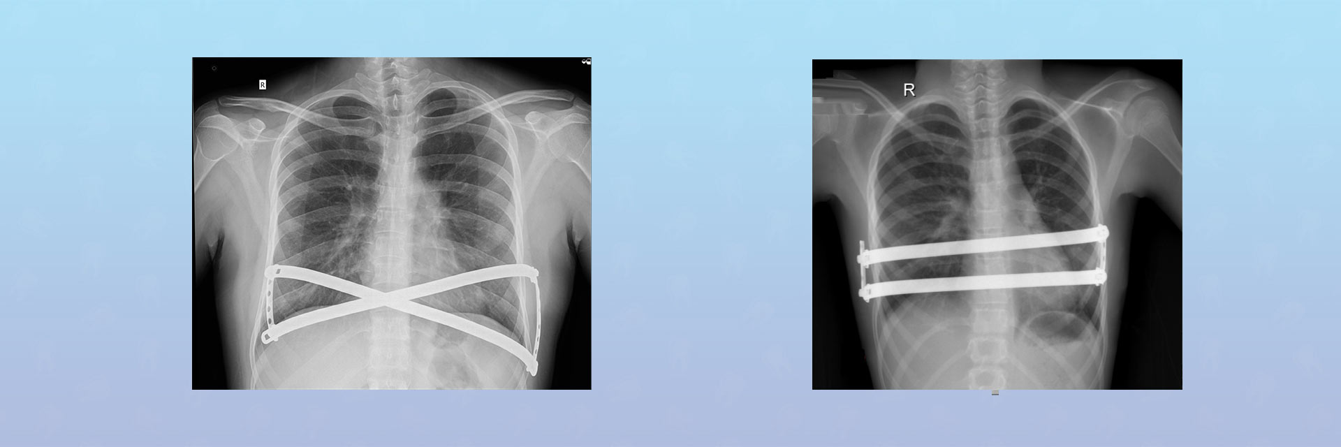 Why It Is Important To Choose The Best Thoracic Surgeon In India