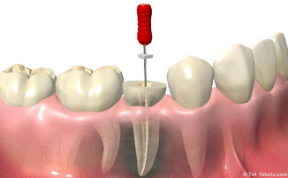 Eigene Zähne mit einer Wurzelbehandlung so lange wie möglich erhalten mit neuester Technik in der Zahnarztpraxis Pilsl in Garmisch-Partenkirchen © tnt fotolia.com