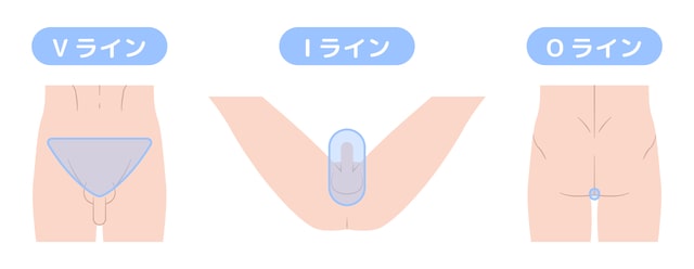 VIO脱毛