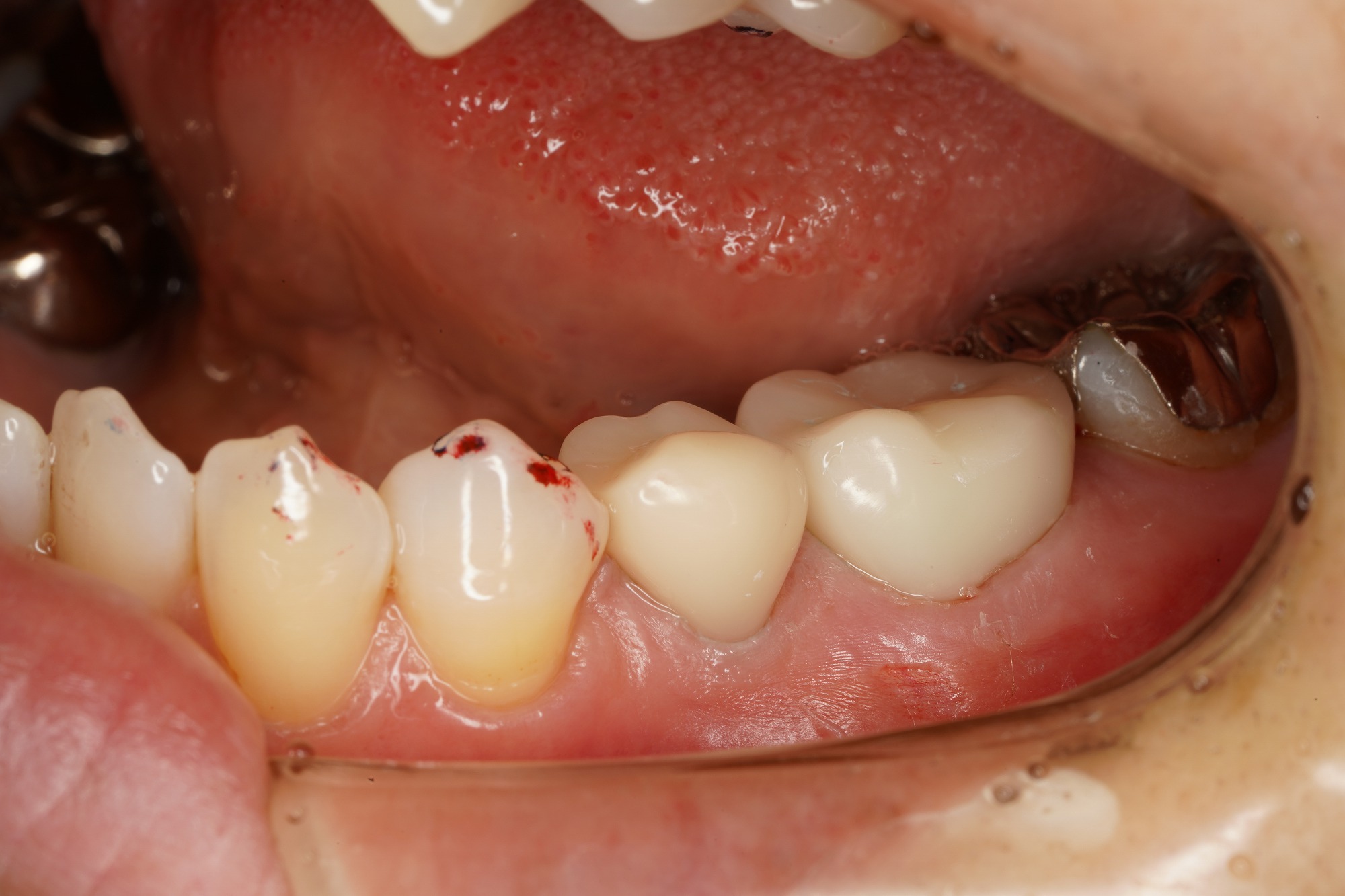 保険 適用 の 白い 歯
